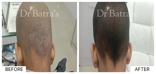 Hair Falling Treatment